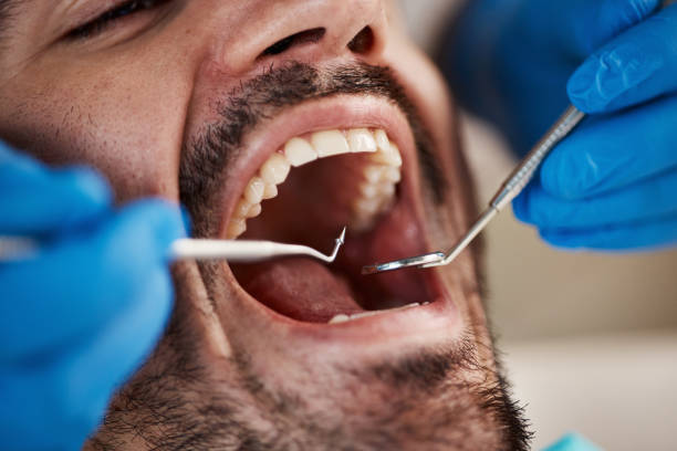 Best Emergency Wisdom Teeth Removal in Bedford, VA